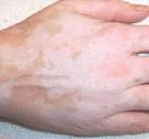Qué cura es buena para el vitiligo