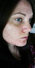Qué es y cómo curar el acné
