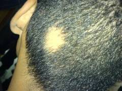 Tratamientos caseros para enfermedades del cuero cabelludo