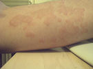 Alergia en la piel