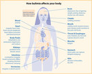 Bulimia nerviosa
