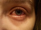Infección ojos