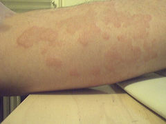 Alergia en la piel