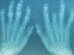 Ejercicios para la artritis