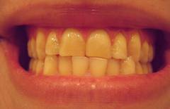 dientes