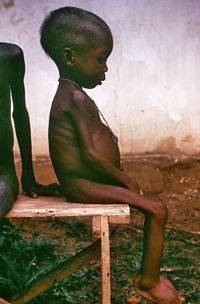 Qué es la desnutrición infantil