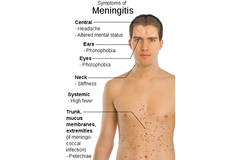 Sintomas de meningitis