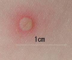 Vesícula de varicela